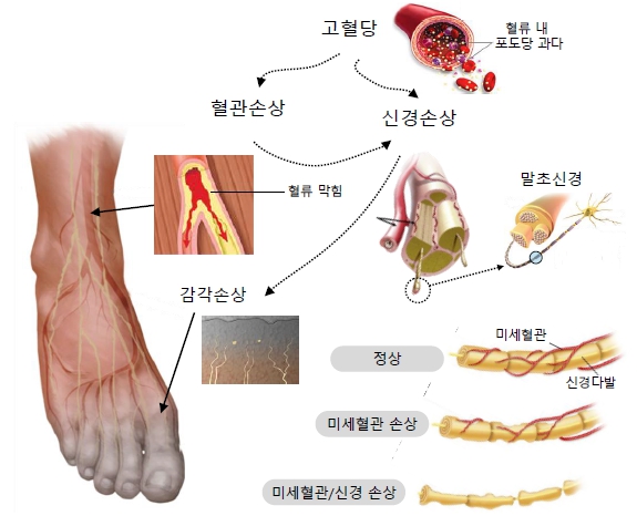 이미지: 당뇨병성 신경병증(DPN)