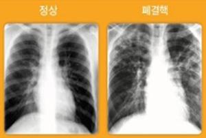 이미지: 흉부 X선 검사