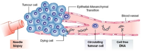 이미지: 조직생검과 액체생검 차이