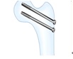 이미지: (Cannulated Screw)