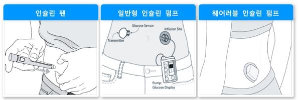 이미지: [인슐린 주입기 종류]