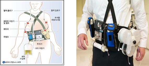 이미지: [Gura교수의 웨어러블 인공신장 개요]