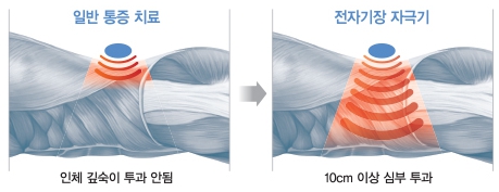 이미지: 전기자극과 자기자극 비교