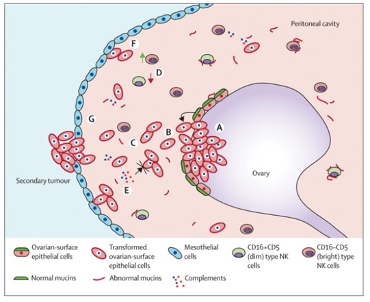 이미지: 난소암생성과정