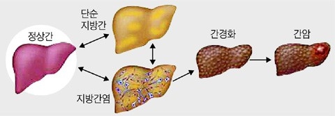 이미지: [비알콜성지방간염(nsah)의 발병 및 악화 과정]