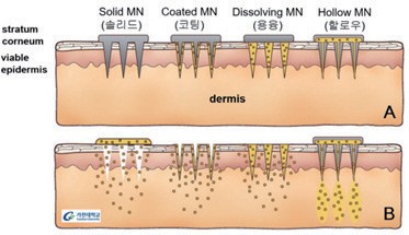 이미지: [그림 2] 마이크로니들의 종류 : 솔리드, 코팅, 용융 그리고 할로우 마이크로니들