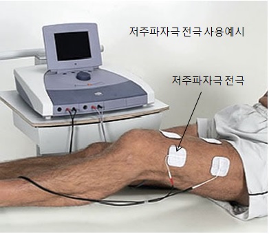 이미지: 저주파자극 사용 예시
