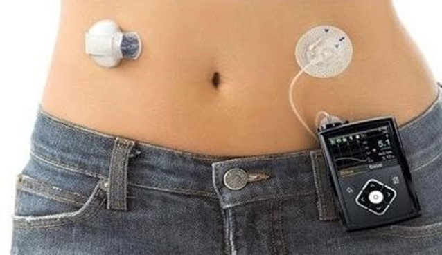 이미지: [세계최초의 본격적인 인공췌장 솔루션인 Medtronic사의 minimed 670g]