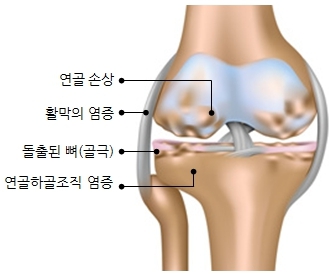 이미지: 사업의내용_골관절염