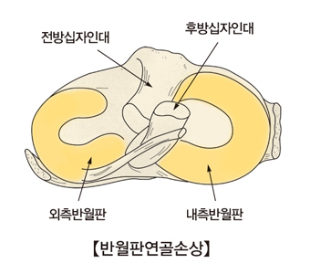 이미지: 사업의내용_반월판연골손상