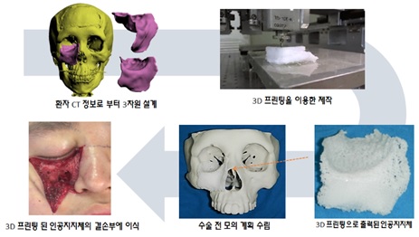 이미지: [티앤알 PSI(Patient Specific Implant)의 공정도]