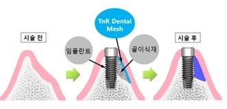 이미지: [티앤알덴탈 메쉬 및 플러스의 임상적용 모식도]