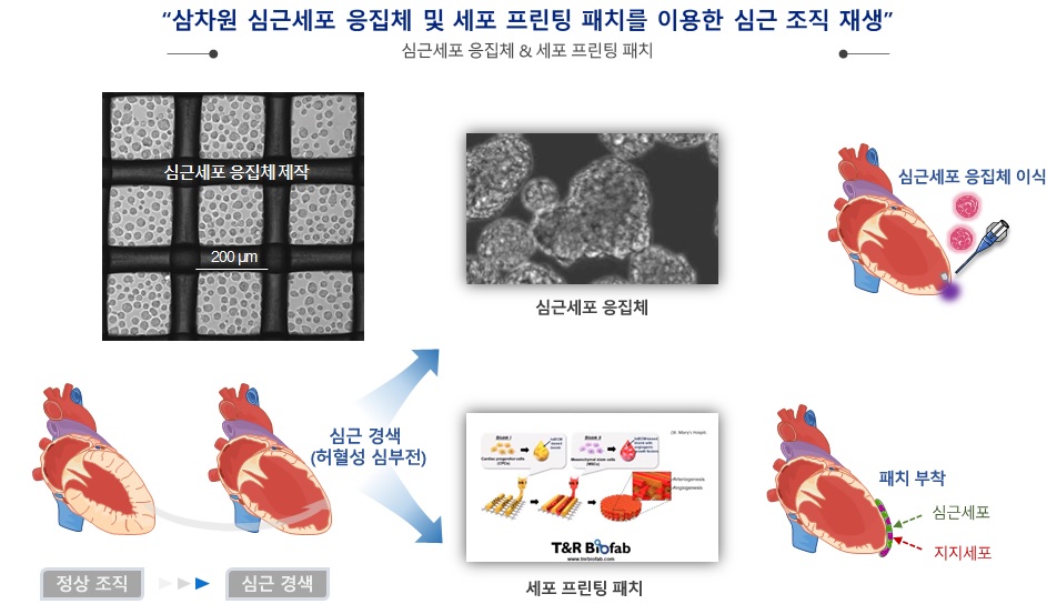 이미지: 심근경색 세포 치료제