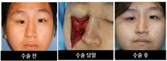 이미지: [수술전 &nbsp; &nbsp;수술당일 &nbsp; &nbsp;수술후]