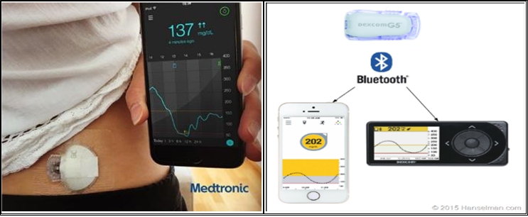 이미지: [미국 medtronic사 연속혈당센서(좌)와 dexcom사 수신기(우)]