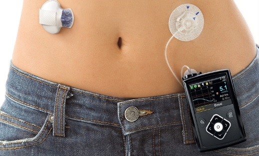이미지: [Medtronic사의 MiniMed670g 인공췌장 시스템]