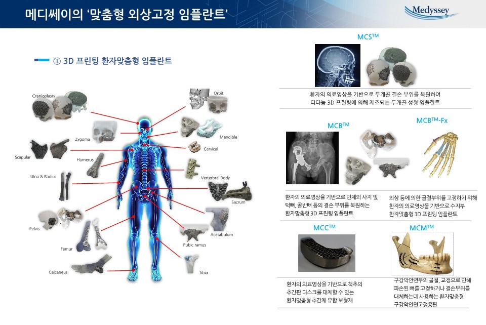 이미지: 제품_맞춤형 외상고정 임플란트-1