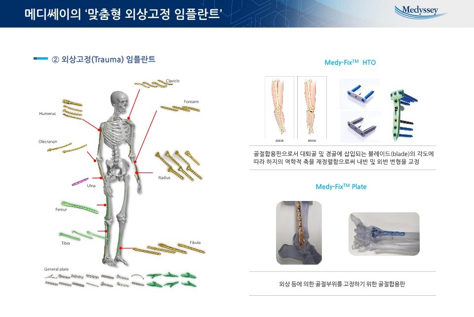 이미지: 제품_맞춤형 외상고정 임플란트-2