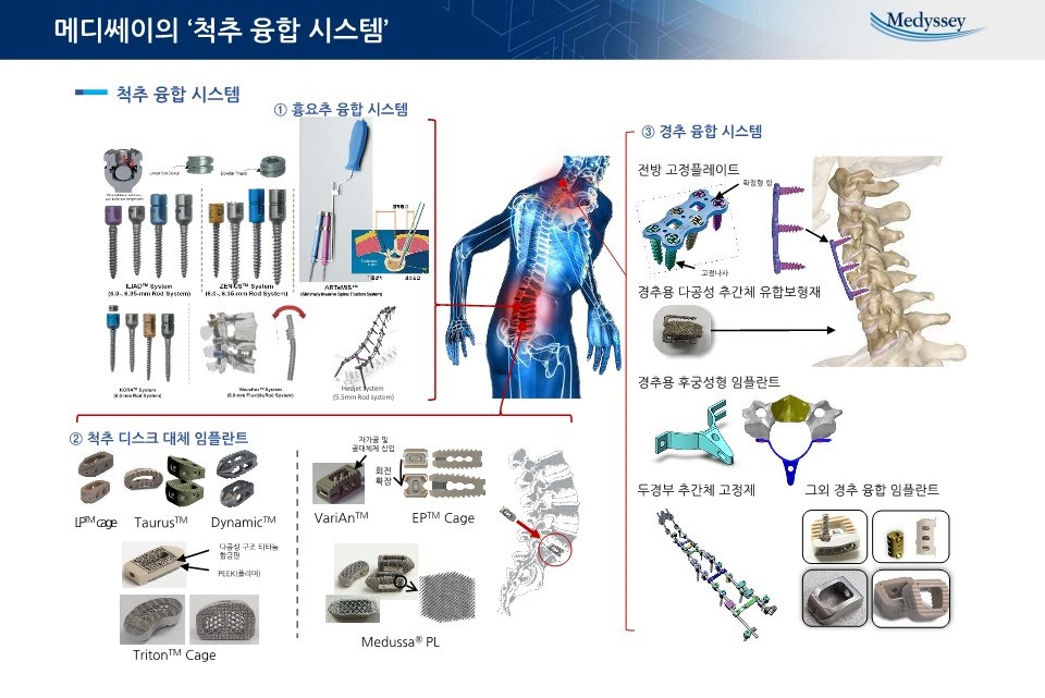 이미지: 제품_척추융합시스템