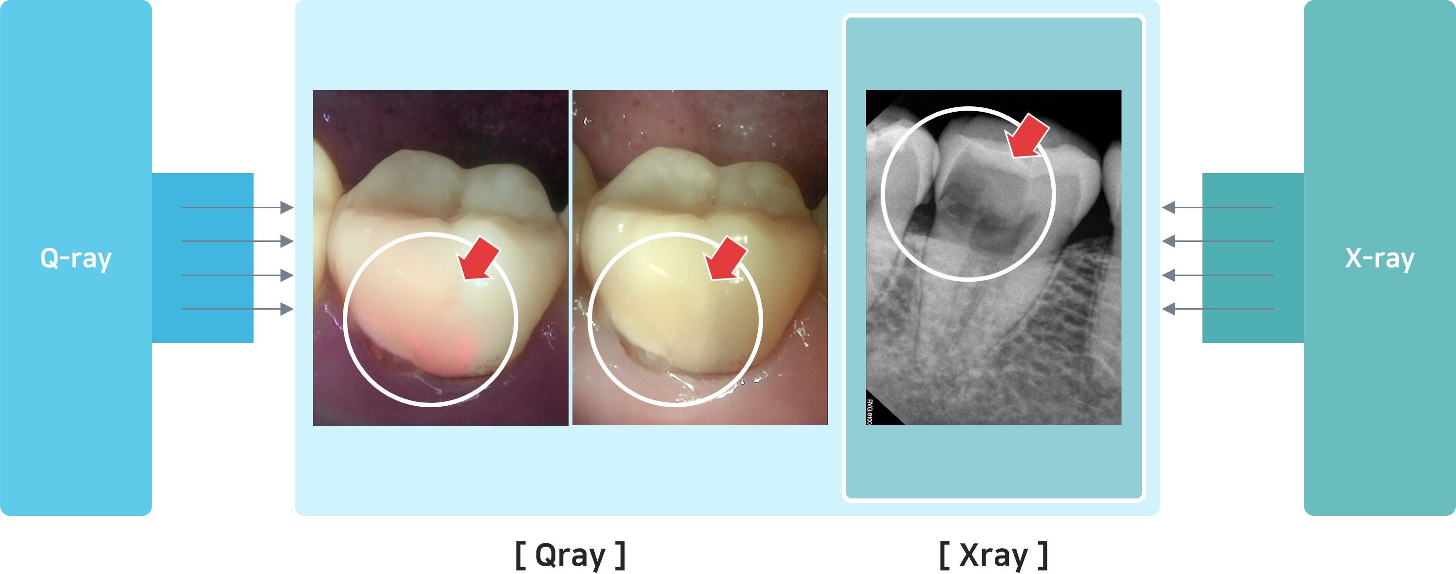 이미지: [Q-ray 와 X-ray_진단검사 병용]