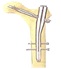 이미지: (Dyna Locking Trochanteric Nail /DLA/IMN)