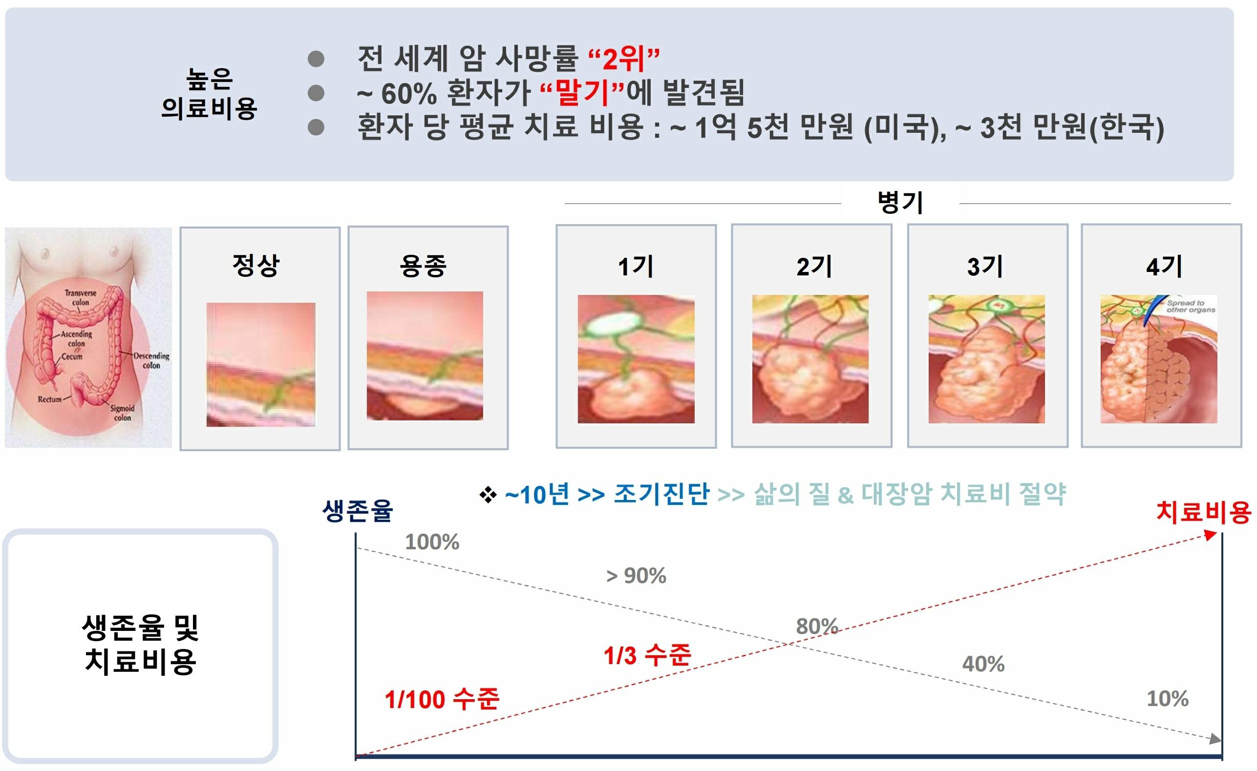 이미지: [체액기반 암 조기진단의 필요성(대장암 사례)]