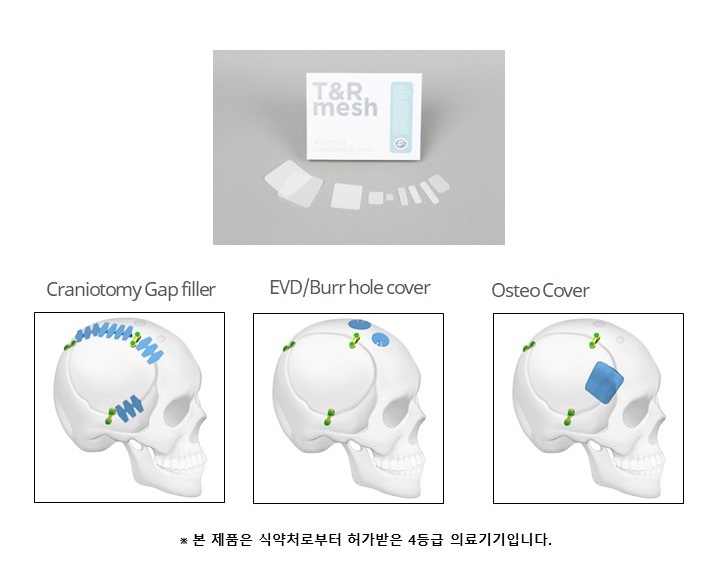 이미지: CFI (Craniofacial Implant)