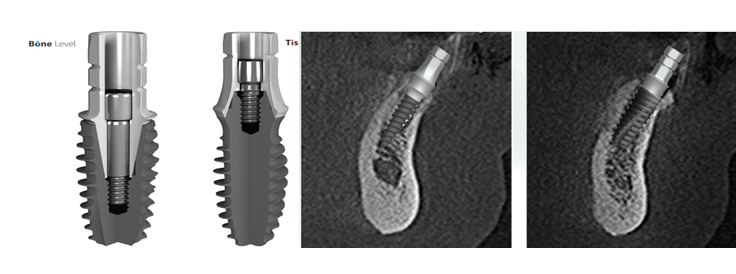 이미지: 브라이트 임플란트