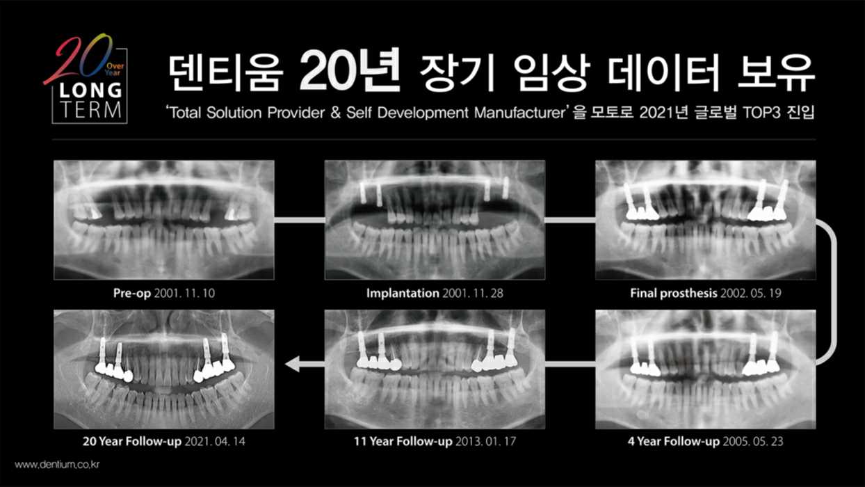 이미지: dentium_implantium_20yrs_long_term