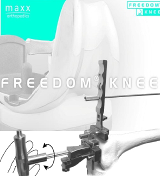 이미지: 인공무릎관절