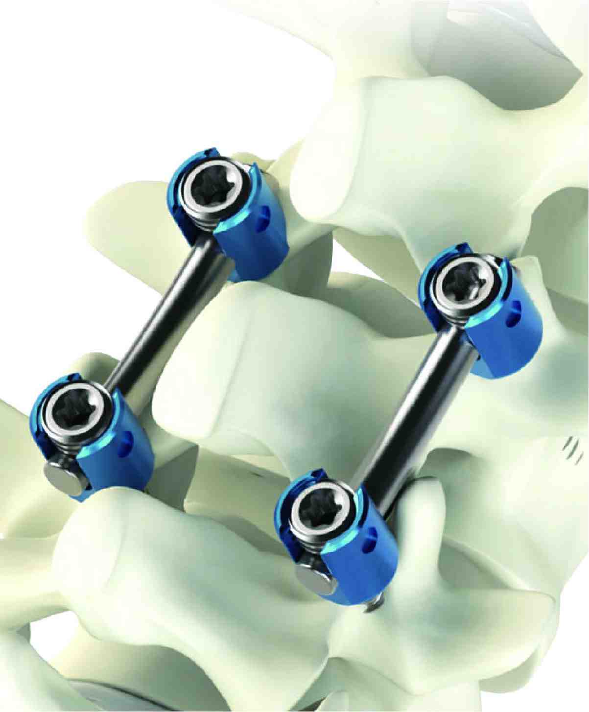 이미지: 척추내 고정장치