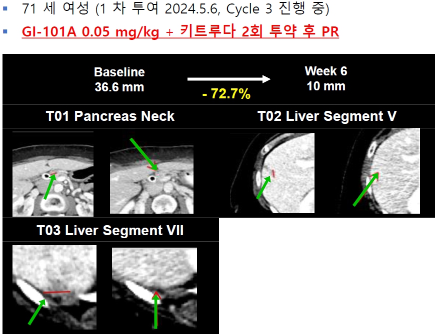 이미지: GI-101A + 키트루다 병용요법 부분관해 사례