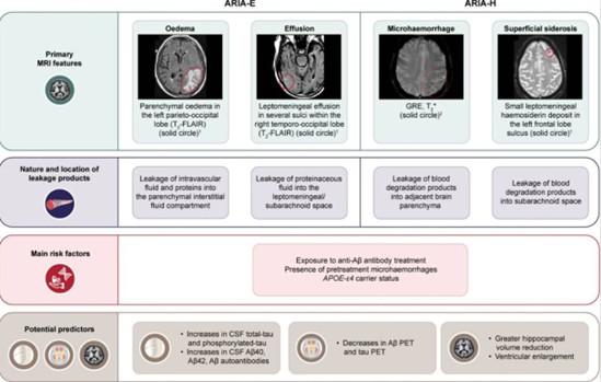 이미지: [ARIA 부작용의 대표적인 MRI 이미지]