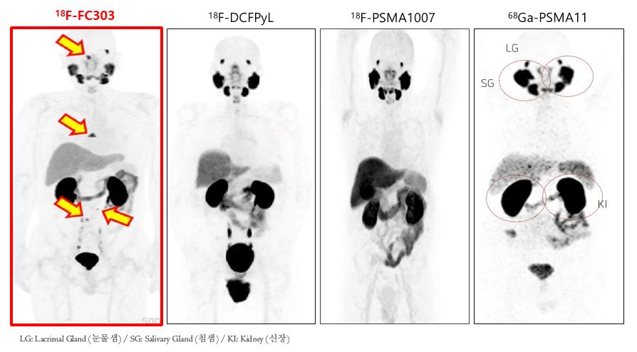 이미지: 전립선암 진단용 방사성의약품 비교 영상(출처 journal of nuclear medicine)