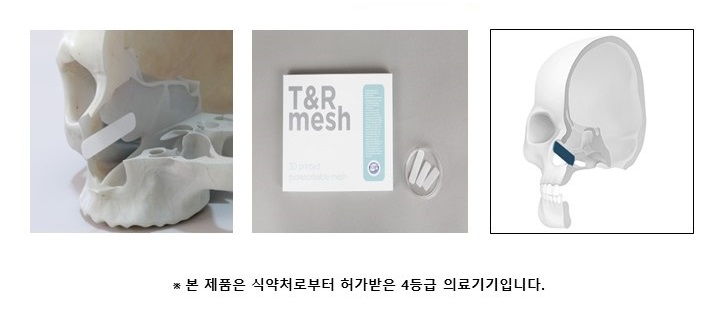 이미지: Nasal Mesh