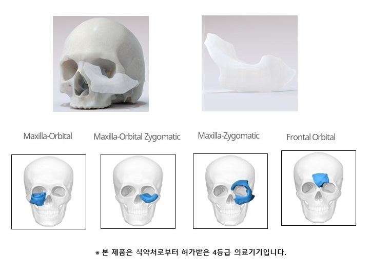 이미지: PSI (patient specific implant)