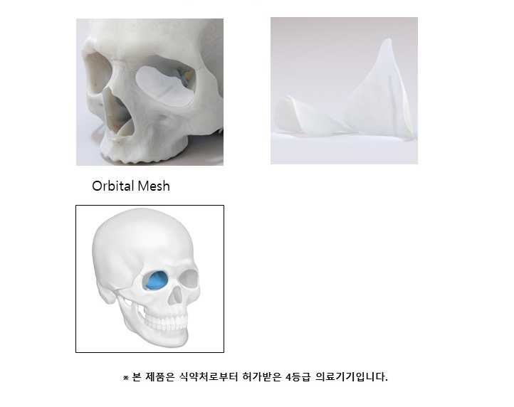 이미지: TNR Mesh (Orbital Mesh)