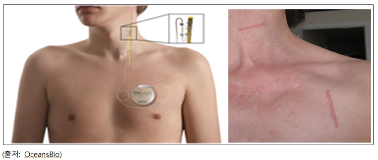 이미지: 인체 삽입 후 모습