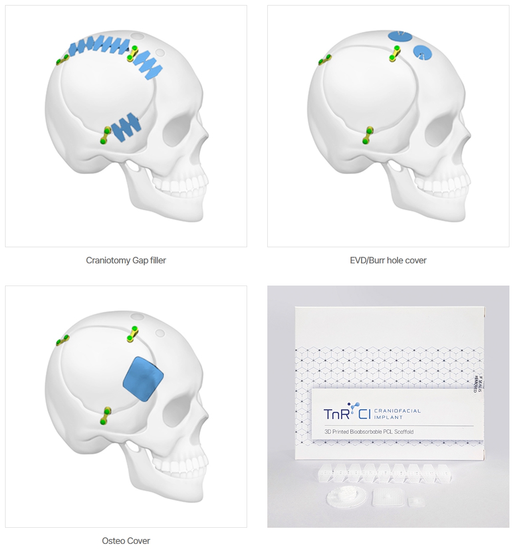 이미지: cfi (craniofacial implant)