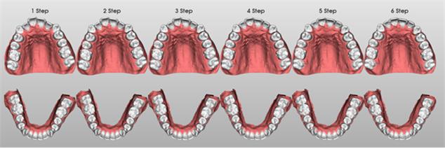 이미지: [ LaonSetup 인공지능 단계별 치아 자동정렬 ]